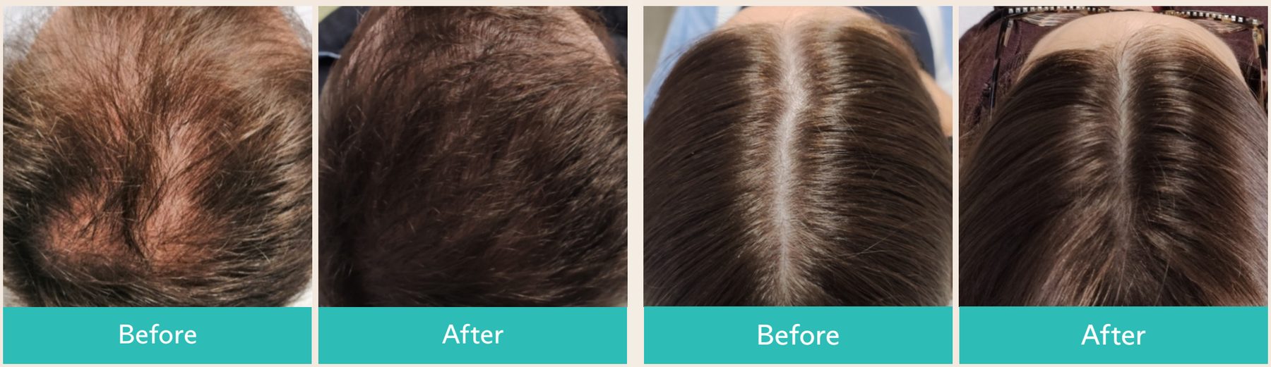 FoLix before and after photos from Lumenis's clinical program: a man's thinning crown showing fuller coverage after treatment, and a woman's widening part line showing a narrower part after treatment