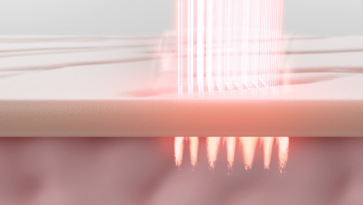 Diagram of a fractional laser beam penetrating the skin surface in a column pattern