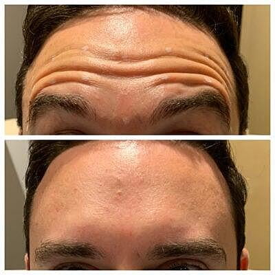 Men's Forehead Treatment