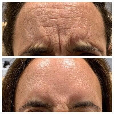 Glabella & Forehead Treatment